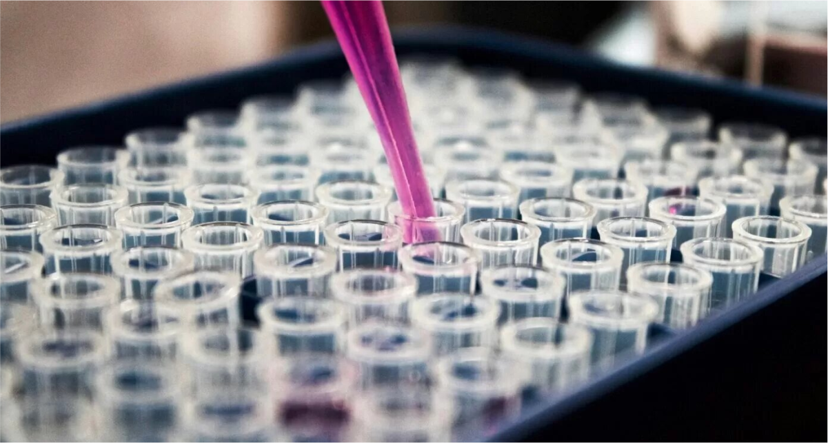 Alzheimer Avançam Pesquisas pela análise com exame de sangue