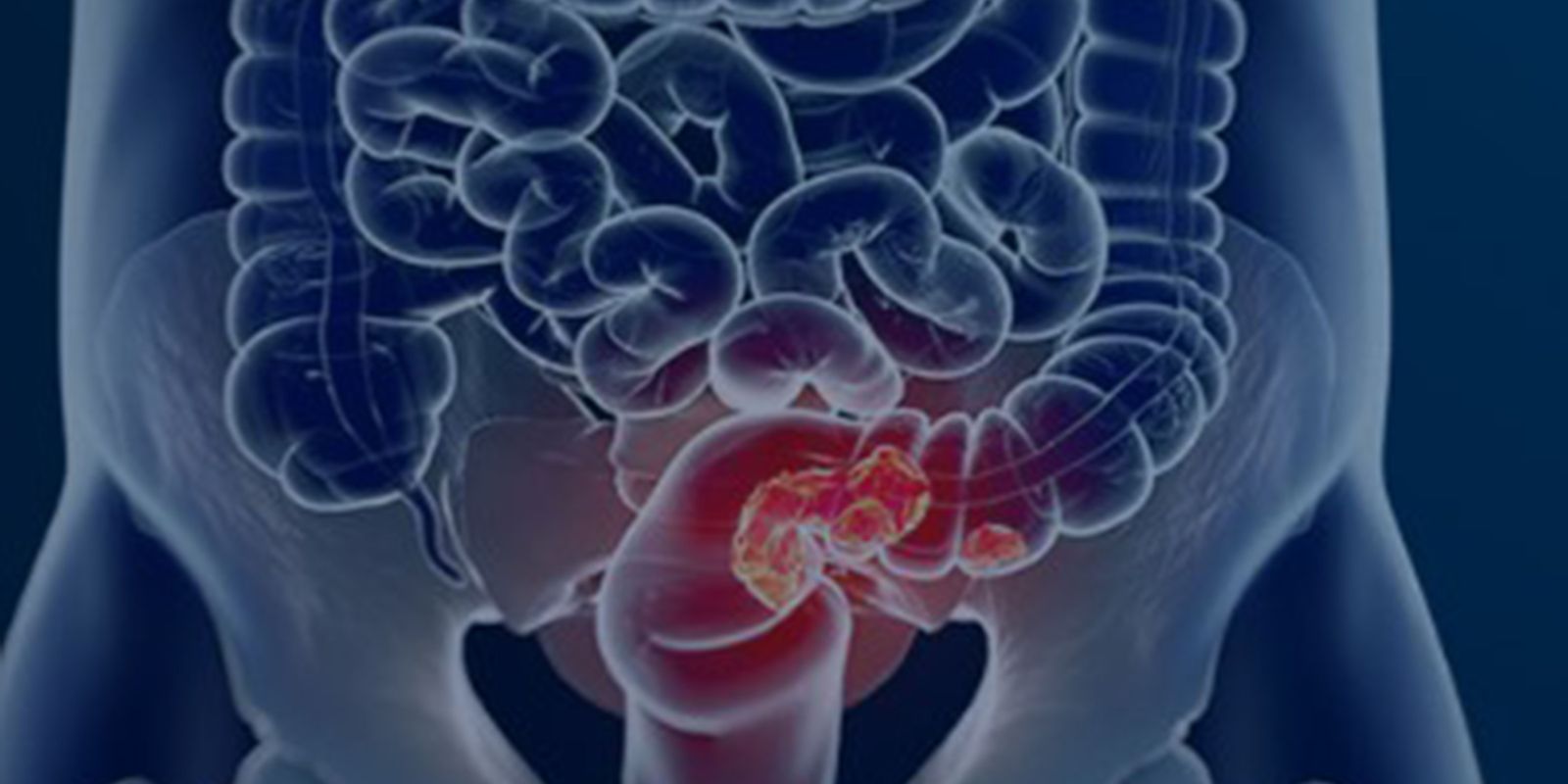 Câncer Colorretal: Diagnóstico Tardio Compromete Cura